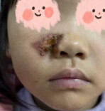 火星溅面险留疤！4岁女童春节被鞭炮烫伤 省儿童医院已接诊近20例