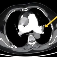 24小时长途车程突发晕厥，竟是经济舱综合征作祟