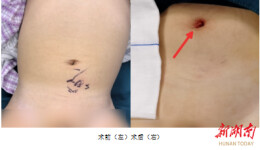 “蛋蛋”去哪儿了？郴州市儿童医院单孔腹腔镜技术，微创无痕守护男宝健康