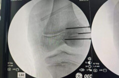 男孩双腿长短差4厘米，5年求医终获救治