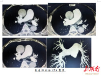 技术前沿丨微创介入再突破！邵阳市中心医院成功开展肺动脉血栓清除术
