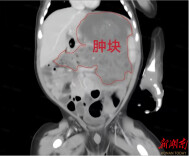 贯穿整个胃壁！湖南罕见新生儿胃巨大畸胎瘤被成功切除