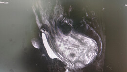 13斤巨瘤“扎根”盆腹腔 妇产科团队精准“拆弹”