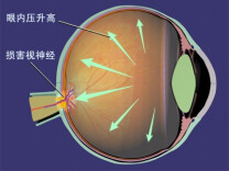 【科普】青光眼早防早治，这些知识要知道