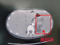 持续腹痛以为是肠胃炎？12岁女孩突发罕见脾扭转，医生紧急施救