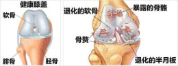 老年人膝关节疼痛怎么办？专家这样说