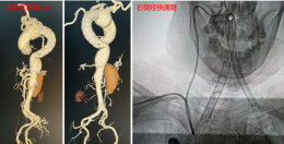 身负三颗“炸弹”又逢颅内出血，湘雅三医院神经外科精准拆弹