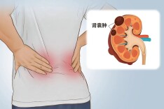 肾脏长了“水泡”？别慌，这样处理就对了