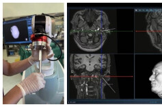 全省首例！机器人“导航”精准治疗面瘫，仅留针眼大小创口