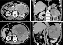 两例巨大肾上腺皮质癌患者获救