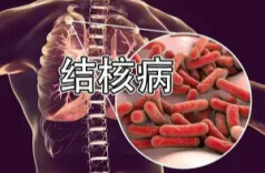 科普视频｜《干掉耐药结核病的指南》，为你揭晓耐药结核病的秘密