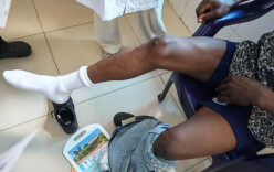 援塞医疗队为他找到膝关节里的“隐匿杀手”