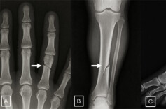 AI伪造X光片，放射科医生也“看走眼”