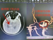 脑动脉瘤破裂命悬一线 长沙泰和医院神经外科妙手施救转危为安