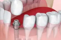 AI“算”出种植牙涂层新材料 破解“种得上、留不住”难题