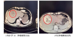 乐极生险！肝癌患者跳广场舞致肿瘤破裂，介入栓塞术化险为夷