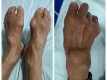 酒瘾戒不掉，小心关节被“啃食”