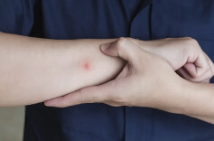 网友晒出2026年的第一个“蚊子包”，蚊子到底偏爱哪些人？