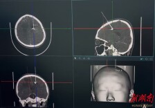 男孩“改装”射钉枪，一枚钢珠竟穿颅射入大脑！