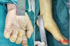 糖尿病患者总手麻腿麻？别忍！这项微创技术能“通神经”
