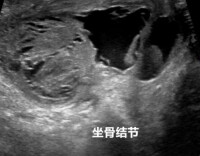 “钥匙孔”手术巧除坐骨结节囊肿 告别坐立不安