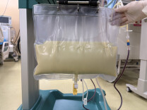 万幸！“牛奶血”急性胰腺炎孕妇，成功“换血”并娩出龙凤胎