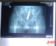 一次好奇两次手术 警惕磁力珠成儿童“隐形杀手”