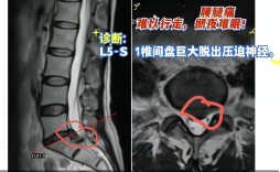 精准微创，快速康复！UBE镜下纤维环缝合术为腰椎间盘突出患者重获“腰”自由！
