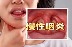 咳了半年不见好？原来不是肺的问题，是咽喉在“报警”