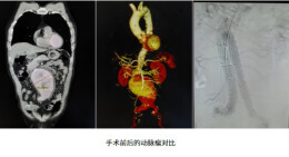 妙手回春，湘雅三医院专家为患者拆除体内“沉默的炸弹”