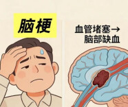 “五一”假期将至，谨防“旅途脑梗”