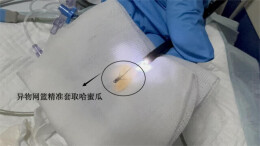 一块哈密瓜引发窒息， 这类人群进食一定要警惕→