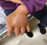 戴手套！“72小时可夺命”，又有人中招了