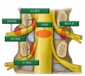 “微创钥匙”为腰椎间盘突出患者重启健康生活