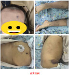 孩子身上长满小红点？警惕免疫系统“乌龙”
