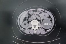体检查出肾囊肿、肾错构瘤？别慌，看这篇就够了