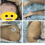 孩子身上长满小红点？警惕免疫系统“乌龙”
