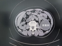 体检查出肾囊肿、肾错构瘤？别慌，看这篇就够了