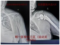 六旬奶奶身受多重骨伤  这家医院成功实施反向全肩关节置换