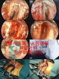 郴州市第一人民医院脊柱外科再添新技术 成功应用国产LUSE技术完成颈椎手术