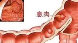 健康科普｜藏在消化道里的“定时炸弹”——胃肠息肉