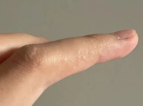这种夏天手上爱长的小水疱，到底是什么？（附应对方法）