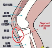 全国爱膝日｜青少年高发膝伤，别当成“生长痛”