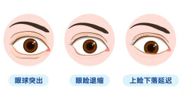 【科普】甲状腺生病，眼睛为何受累？了解“甲亢突眼”