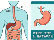 夏日喝啤酒总烧心反酸？别把胃病当成小毛病