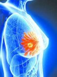 一次手术为局部晚期乳腺癌患者完成“根治+重建”