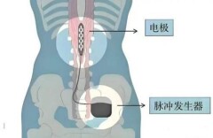 脊髓电刺激术，助偏瘫患者重新行走