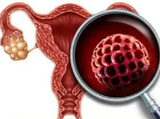 全球1.7亿女性困扰、用了90多年的疾病名称：多囊卵巢综合征为何更名？