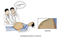 汛期谨防血吸虫病！一旦感染，切勿拖延成“大肚子”
