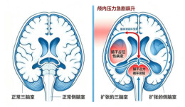 头痛到昏迷仅几小时！医生提醒：脑积水早期症状像感冒 救治不及时可致命
